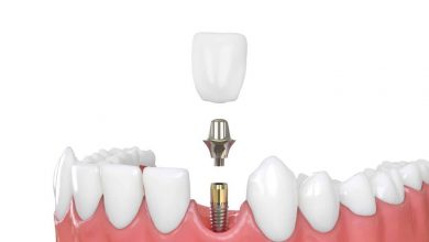 stop-living-with-gaps:-explore-dental-implants-brisbane-for-a-permanent-solution